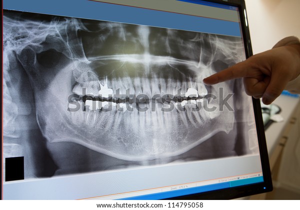 Panoramic dental X-Ray with hands point in\
Computer screen