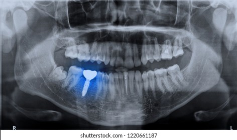 Panoramic Dental X-ray Image Mouth Of Adult Man And Single Dental Implant With Crown Attached Used For Tooth Replacement, With Indicated With Treatment Area