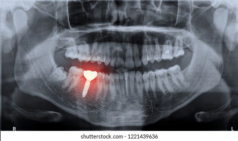 Panoramic dental x-ray image mouth of adult man and single dental implant with crown attached used for tooth replacement, with indicated with painful area