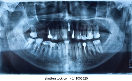 Panoramic Dental X-Ray With Implant