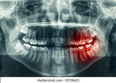 Panoramic dental X-Ray, with red painful area