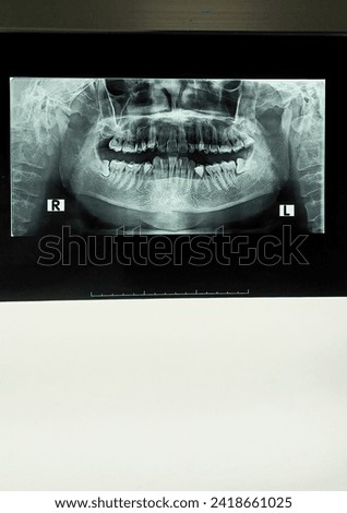 Panoramic image dental x-ray of adult with diagnostic of impaction at radiology viewing box. Roentgen teeth upper and lower jaw.