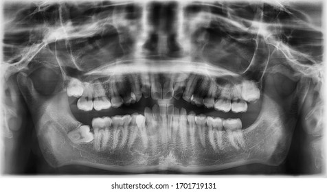 Panoramic radiograpgh showed left and right embedded maxillary third molar and right impaction mandibular third molar.