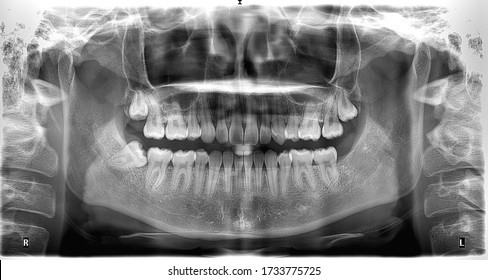 Panoramic radiograpgh showed lower right third wisdom tooth and bilateral third molar embedded teeth at maxilla