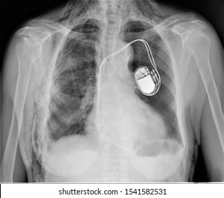 a panoramic radiograph of the chest implanted cardiac pacemaker,medical diagnostics ,cardiology