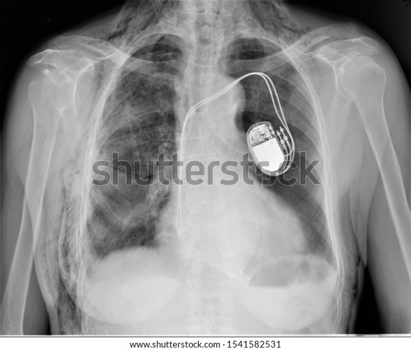 Panoramic Radiograph Chest Implanted Cardiac Pacemakermedical Stock ...