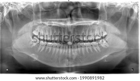 Panoramic radiograph showed missing of upper left permanent canine and prolong retention of left upper deciduous canine.