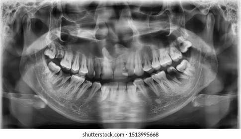 Panoramic Radiograph Showed Unilocular Radiolucency With Embedded Supernumerary Teeth In Cyst Or Cyst Liked Tumour At Maxillary Bone.