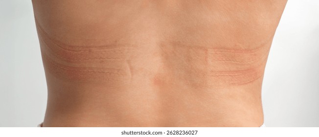 Panoramic view of the bra marks on the back. The girl rubbed her back with her underwear. An uncomfortable bra. The underwear is the wrong size. Traces of clothing on the body.