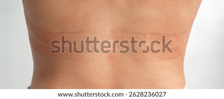 Panoramic view of the bra marks on the back. The girl rubbed her back with her underwear. An uncomfortable bra. The underwear is the wrong size. Traces of clothing on the body.