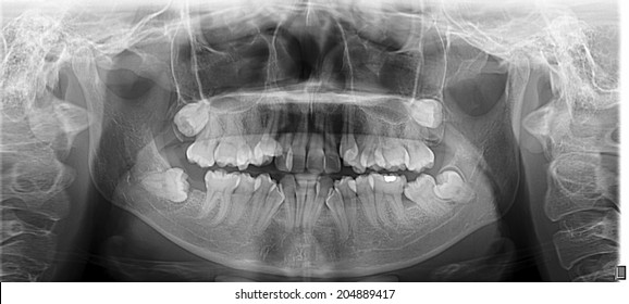 panoramic x-ray of crowding teeth 