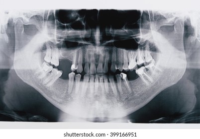 panoramic x-ray of human teeth before implanting