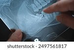 Panoramic x-ray image of teeth and mouth with wisdom teeth