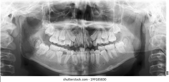 52 Mixed dentition Images, Stock Photos & Vectors | Shutterstock