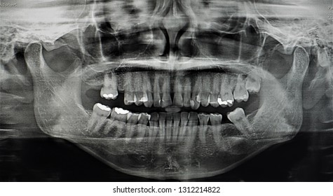 Panoramic Xray Tooth Nasal Sinus On Stock Photo 1312214822 | Shutterstock