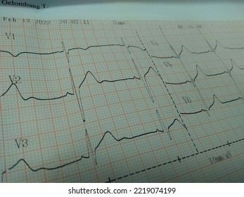 Paper Recording The Heart Rhythm Of A Patient Who Appears Normal.