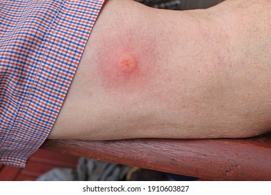 Paper Wasp Bite On The Inside Of A Mans Arm