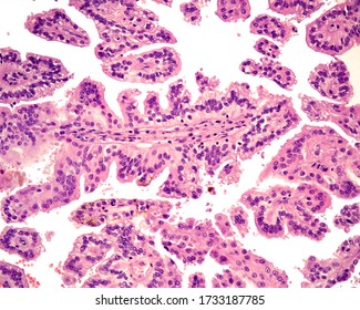 379 Papillary Carcinoma Images, Stock Photos & Vectors 