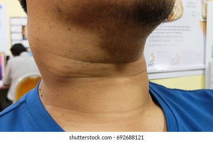 Papillary Thyroid Cancer With Lymph Node Neck Metastasis