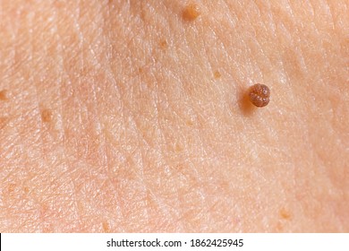 papillomatous skin growth)