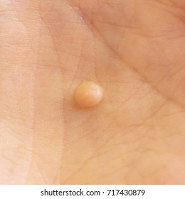 Papilloma on the palm close-up. Macro shot. Warts.