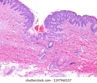 Papilloma Scalp Where Border Between Epidermis Stock Photo 1197960157 ...