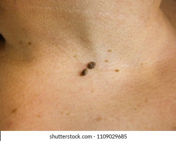 papilloma colli on neck)