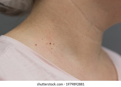 Benign Papilloma Images, Stock Photos & Vectors | Shutterstock