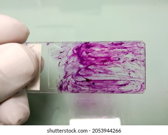 Pap's Smear Of Cytology Papanicolaou's And Pap Stained Glass Slide For Microscopic Examination. To Diagnosis Female Cervical Cancer.