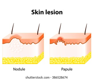 Skin Nodule Images, Stock Photos & Vectors | Shutterstock