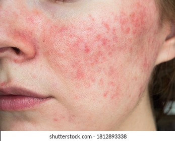 papulopustular rosacea, close-up of the patient's cheek