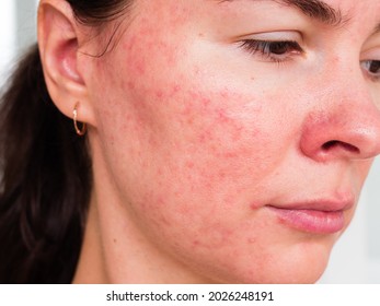 Papulopustular Rosacea, Close-up Of The Patient's Cheek - The Consequences Of Prolonged Wearing Of A Mask