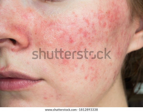 papulopustular\
rosacea, close-up of the patient\'s\
cheek