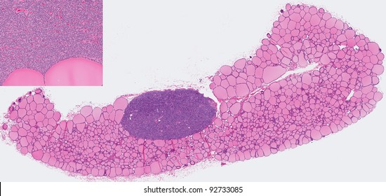 Parathyroid gland (blue oval tissue) embedded within thyroid gland (pink). Inset shows a magnified view of the parathyroid gland cells. Parathyroid gland is important in calcium and bone homeostasis