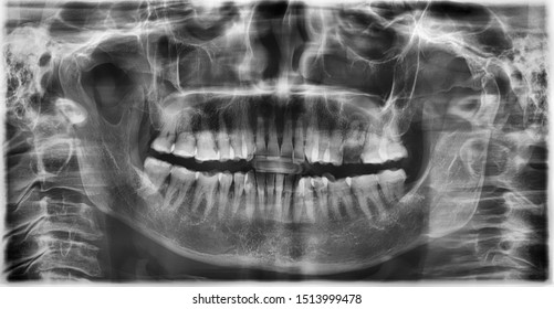 Parnoramic Radiograph Showed Left Maxillary First Molar Nearly Retain Root With No Pathologic Bone Lesion.