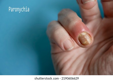 Paronychia Disease Of The Fingernail