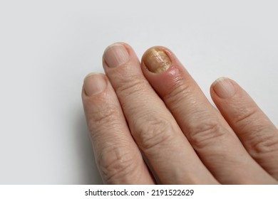 Paronychia Disease Of The Fingernail