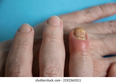 Paronychia Disease Of The Fingernail