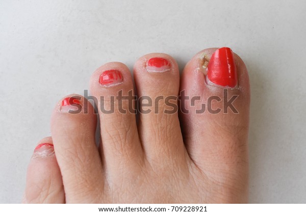 Paronychia Nail Infection On Left Foot Stock Photo (Edit Now) 709228921