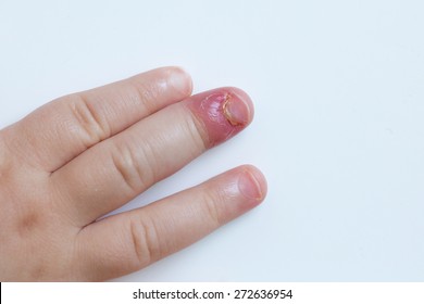 Paronychia High Res Stock Images Shutterstock