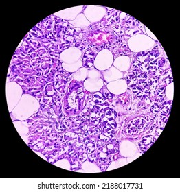 Parotid Gland(biopsy): Chronic Sialadenitis, Show Parotid Tissue, Chronic Inflammation. 40x Light Microscopic View.