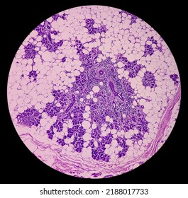 Parotid Gland(biopsy): Chronic Sialadenitis, Show Parotid Tissue, Chronic Inflammation. 40x Light Microscopic View.