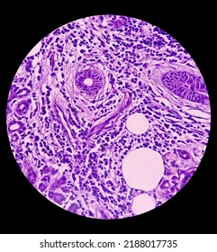 Parotid Gland(biopsy): Chronic Sialadenitis, Show Parotid Tissue, Chronic Inflammation. 40x Light Microscopic View.