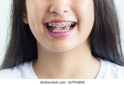 A Part Of Asian Girl Smile With Braces