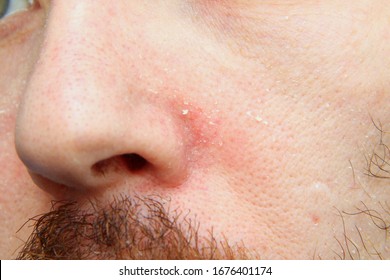 Part Of The Face With The Nose Of An Adult White Man With Dry, Flaky Skin. Skin Problems And Diseases.