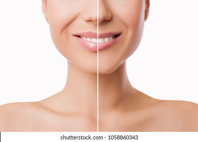 Part of face, young woman close up. Sexy plump lips after filler injection collagen to increase the volume of the lips. Beauty concept. Female lips before and after augmentation procedure