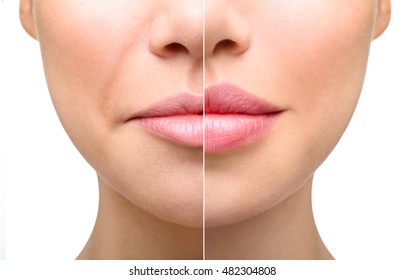 Part of face, young woman close up. Sexy plump lips after filler injection and syringe injection to nasolabial fold. Beauty concept.