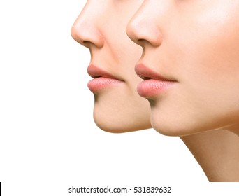 Part Of Face, Young Woman Close Up. Sexy Plump Lips After Filler Injection And Syringe Injection To Nasolabial Fold. Beauty Concept.