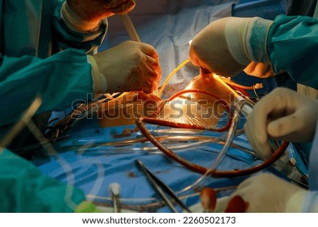 As part of heart operations due to coronary heart disease that are being performed in operating room hospital, coronary artery bypass grafts are being performed