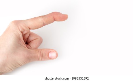 part of left hand showing size, how big, long with index finger and thumb, index finger with a extensor tendon injury, mallet finger, tip bending downwards, deformity in the last phalangeal bone